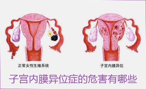 女性要提防子宫内膜异位症！子宫内膜异位症的注意事项