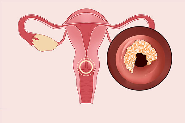 宫颈癌有哪些临床表现